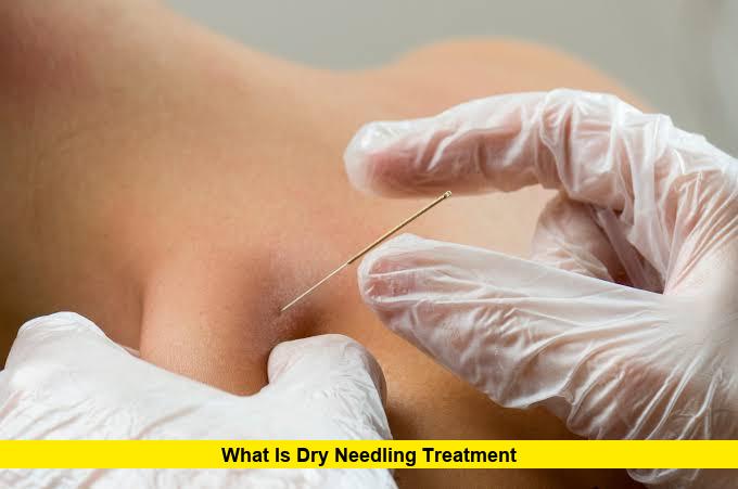What Is Dry Needling Treatment